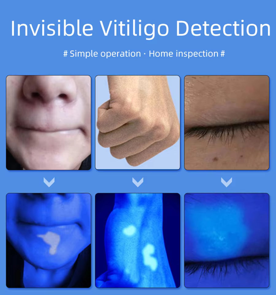 LED Woods Lamp Skin Analyzer with UV Magnifier for Facial Testing